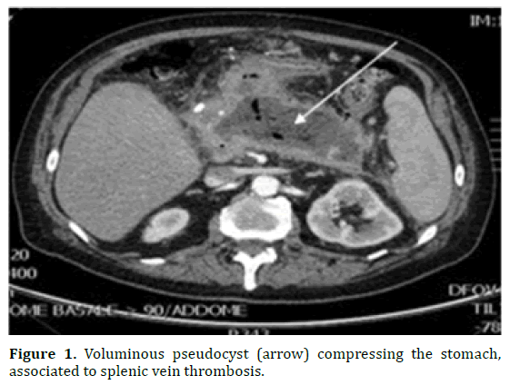 pancreas-voluminous-pseudocyst