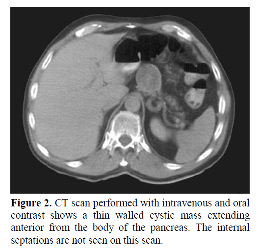 pancreas-walled-cystic-mass-extending