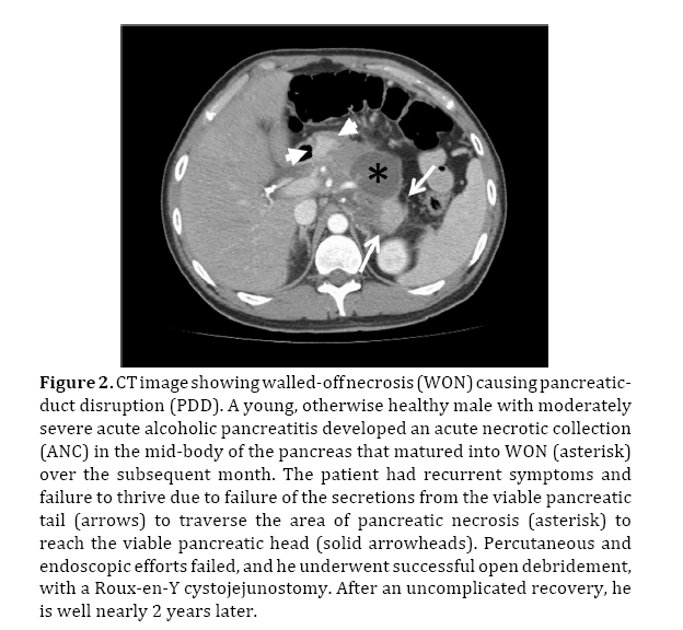 pancreas-walled-off-necrosis