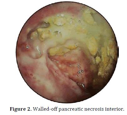 pancreas-walled-off-pancreatic