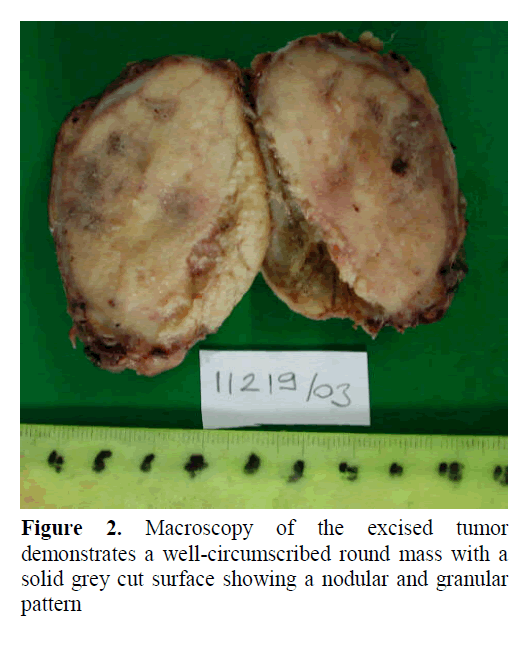 pancreas-well-circumscribed-round