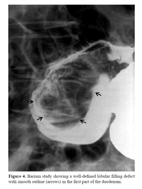 pancreas-well-defined-lobular