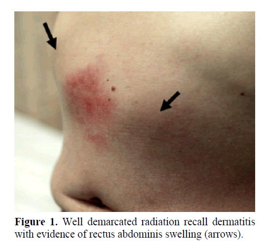 pancreas-well-demarcated-radiation