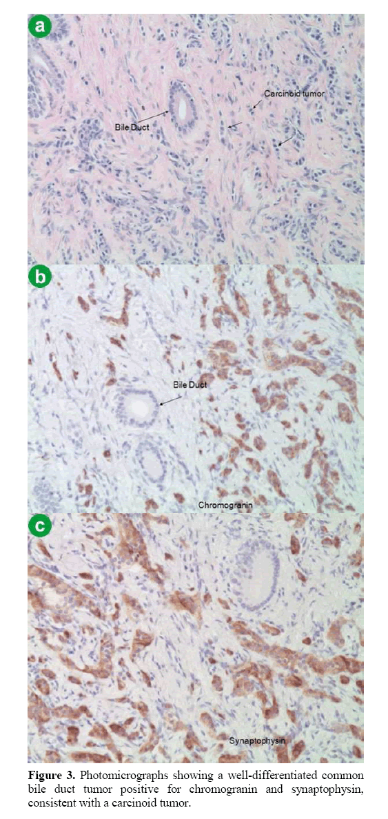 pancreas-well-differentiated-common