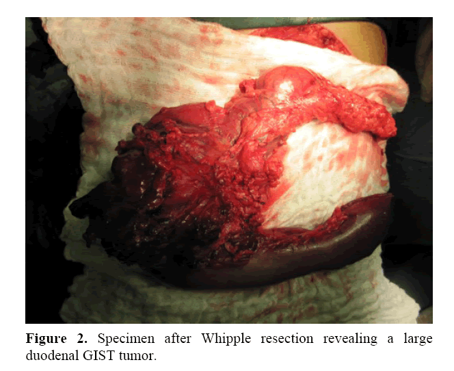 pancreas-whipple-resection-revealing