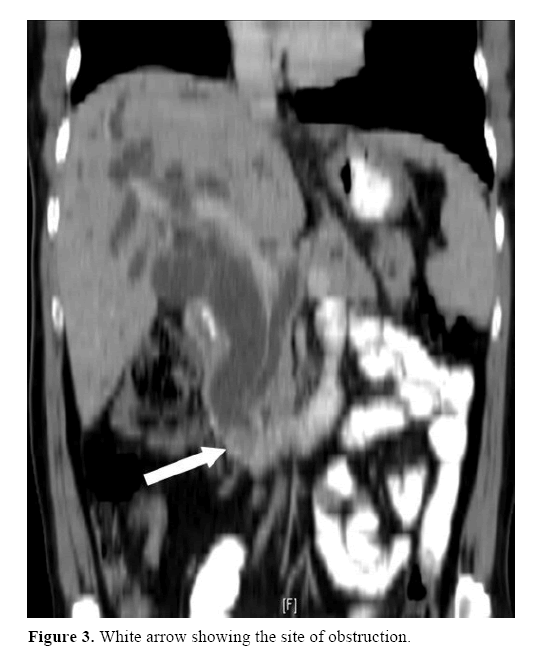 pancreas-white-arrow-showing