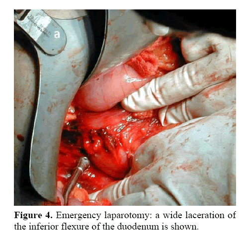 pancreas-wide-laceration