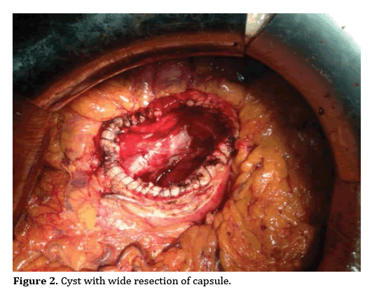pancreas-wide-resection-capsule