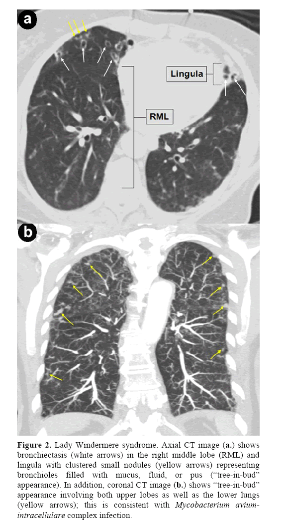 pancreas-windermere-syndrome