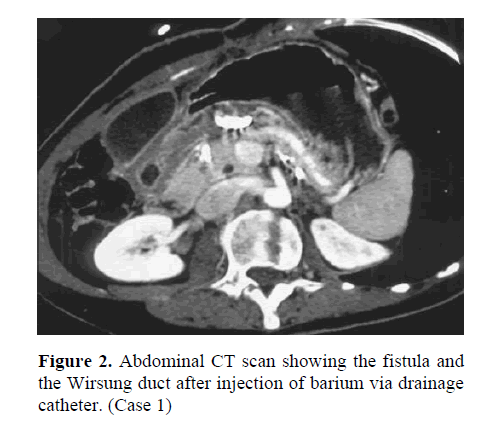 pancreas-wirsung-duct-after-injection