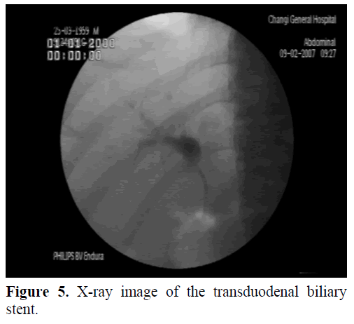 pancreas-x-ray-image-transduodenal-biliary