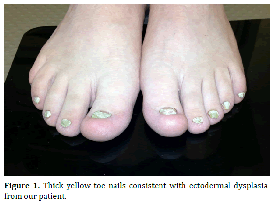 pancreas-yellow-toe-nails
