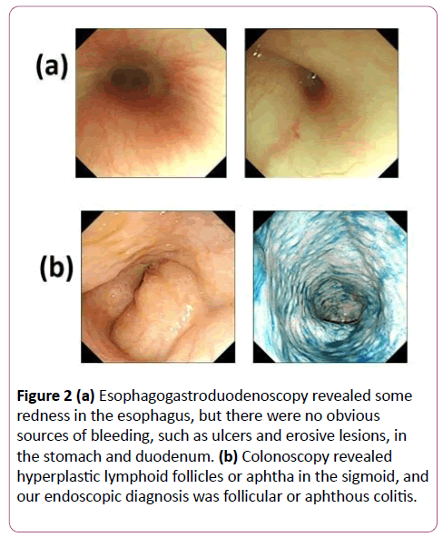 pediatrics-health-research-Colonoscopy-revealed-hyperplastic-lymphoid