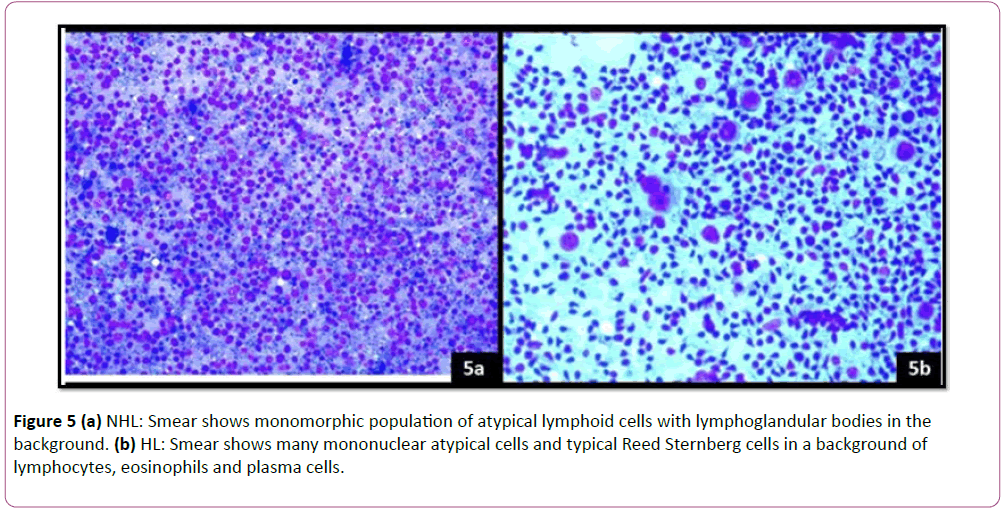 pediatrics-health-research-atypical-lymphoid