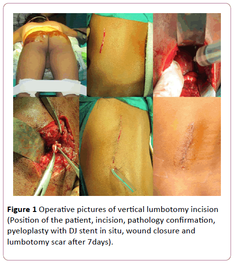 pediatrics-health-research-vertical-lumbotomy-incision