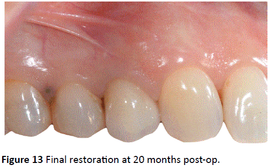 periodontics-prosthodontics-20-months-post-op