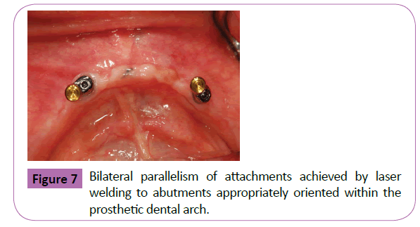 periodontics-prosthodontics-Bilateral-parallelism