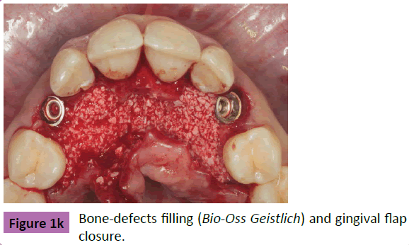 periodontics-prosthodontics-Bone-defects