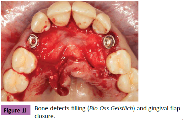 periodontics-prosthodontics-Bone-defects-filling