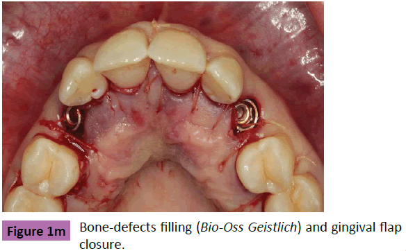 periodontics-prosthodontics-Bone-defects-flap