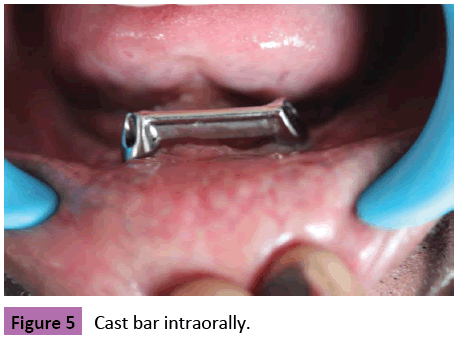 periodontics-prosthodontics-Cast-bar-intraorally