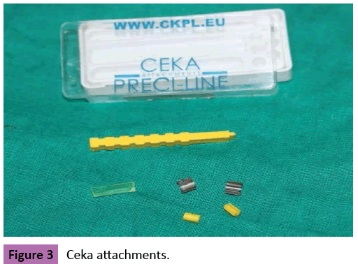 periodontics-prosthodontics-Ceka-attachments