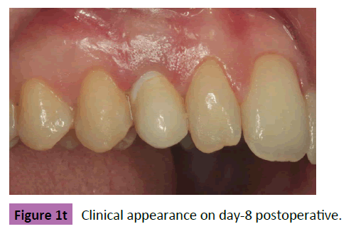 periodontics-prosthodontics-Clinical-appearance