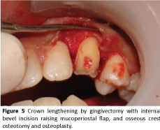 periodontics-prosthodontics-Crown-lengthening-gingivectomy