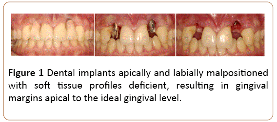 periodontics-prosthodontics-Dental-implants
