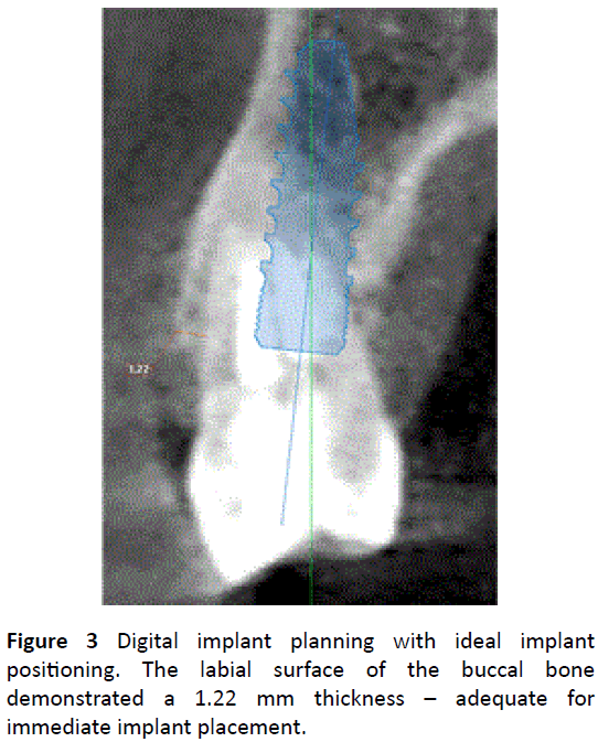 periodontics-prosthodontics-Digital-implant