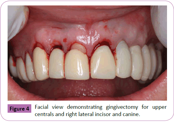 periodontics-prosthodontics-Facial-demonstrating-gingivectomy