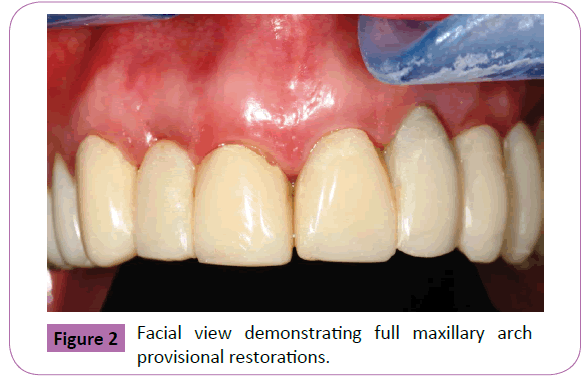 periodontics-prosthodontics-Facial-demonstrating-maxillary