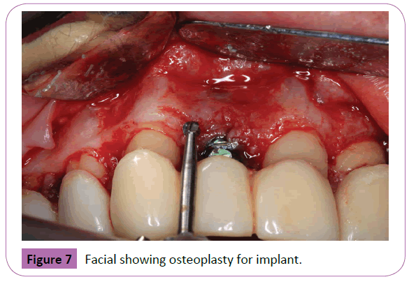 periodontics-prosthodontics-Facial-osteoplasty-implant