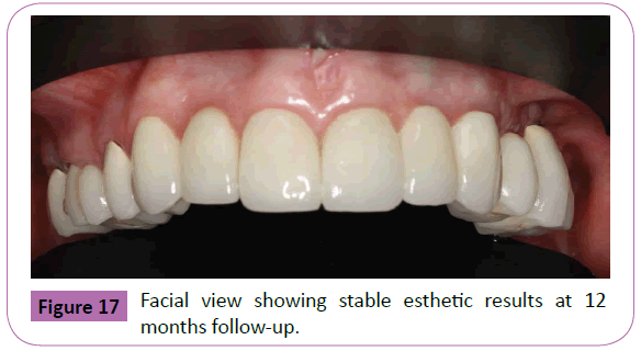 periodontics-prosthodontics-Facial-showing-stable-esthetic