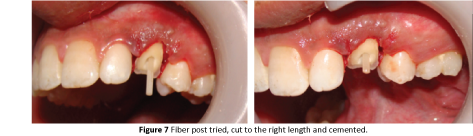 periodontics-prosthodontics-Fiber-post-tried