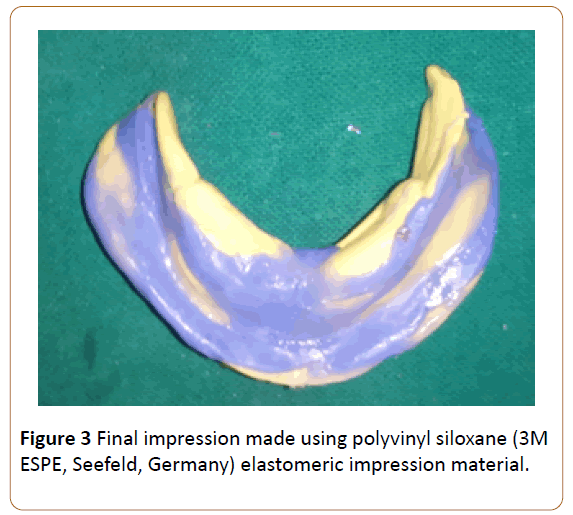 periodontics-prosthodontics-Final-impression