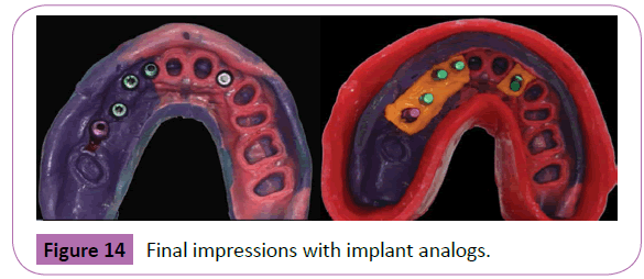 periodontics-prosthodontics-Final-impressions-implant-analogs