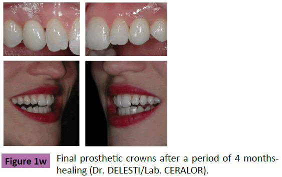 periodontics-prosthodontics-Final-prosthetic
