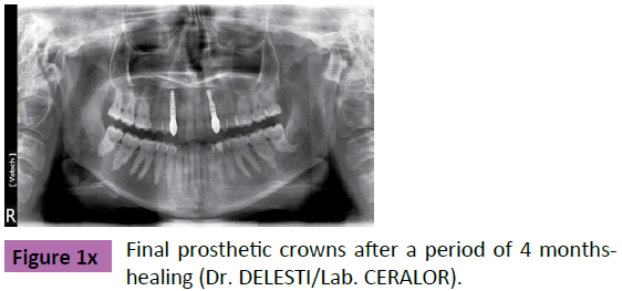periodontics-prosthodontics-Final-prosthetic-crowns