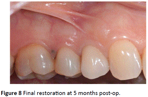 periodontics-prosthodontics-Final-restoration