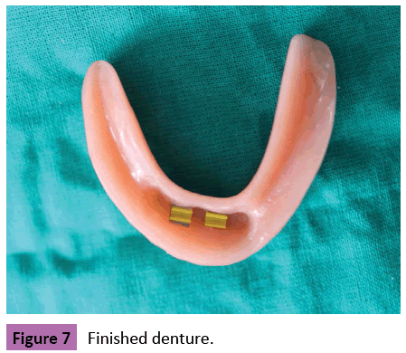 periodontics-prosthodontics-Finished-denture