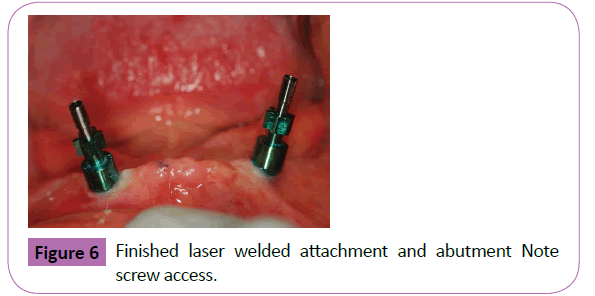 periodontics-prosthodontics-Finished-laser