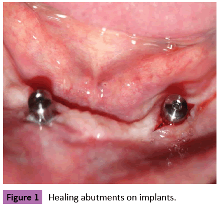 periodontics-prosthodontics-Healing-abutments-implants