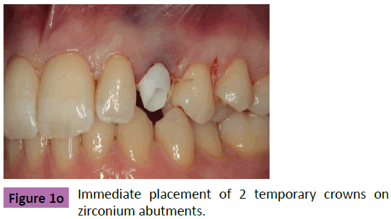 periodontics-prosthodontics-Immediate-placement