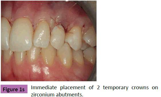 periodontics-prosthodontics-Immediate-placement-abutments