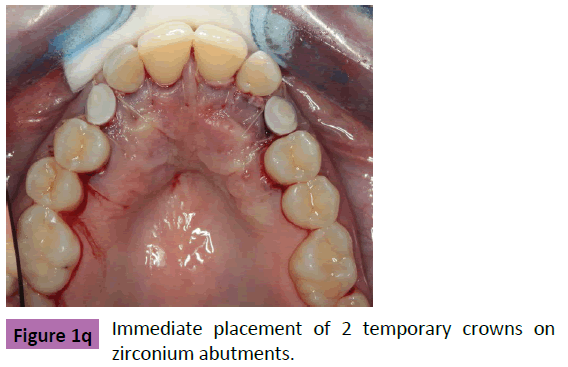 periodontics-prosthodontics-Immediate-placement-crowns