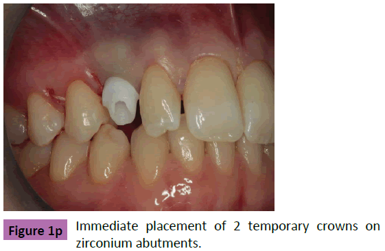 periodontics-prosthodontics-Immediate-placement-temporary