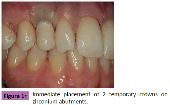 periodontics-prosthodontics-Immediate-placement-zirconium