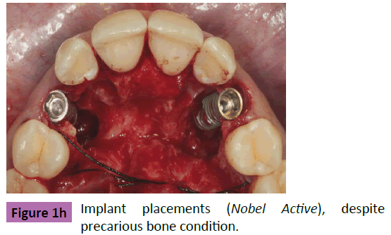 periodontics-prosthodontics-Implant-placements