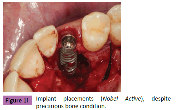 periodontics-prosthodontics-Implant-placements-despite